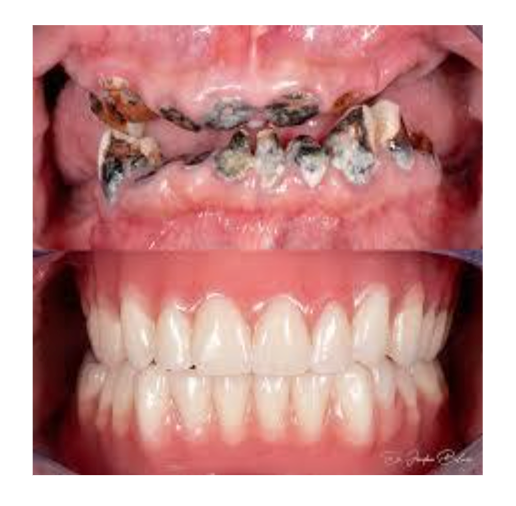 Dentures and Dental Implants in Kalyan Nagar